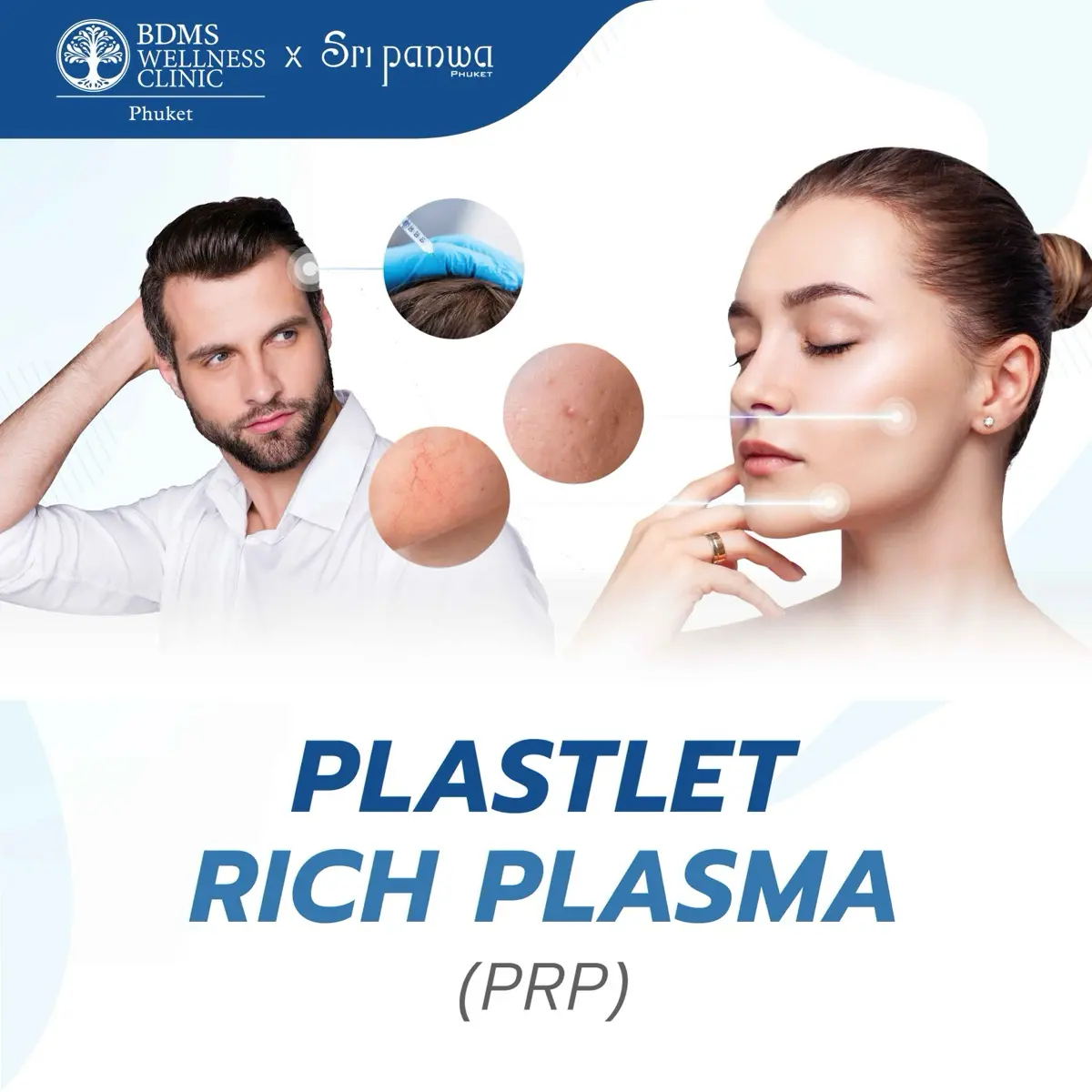 Plastlet Rich Plasma (PRP)