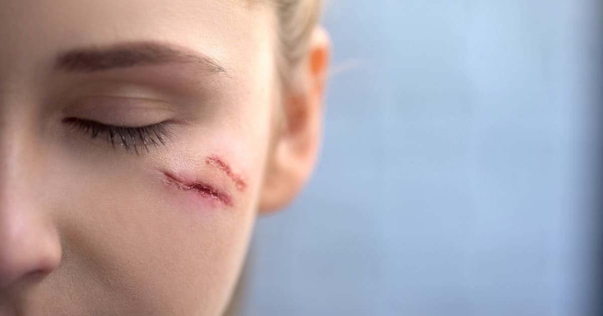 เสริมแต่งใบหน้าและจมูกฟื้นความมั่นใจหลังอุบัติเหตุ