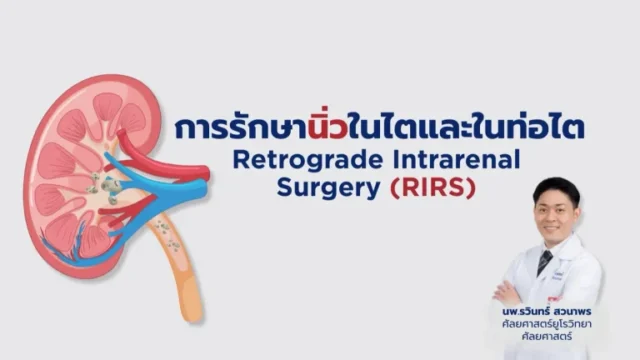 การรักษานิ่วในไตและในท่อไต Image