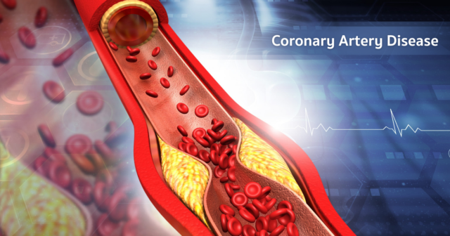 Coronary Artery Disease: The Silent Threat