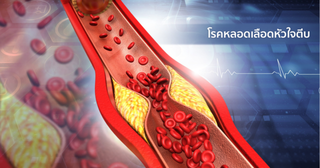 โรคหลอดเลือดหัวใจตีบ (Coronary Artery Disease)