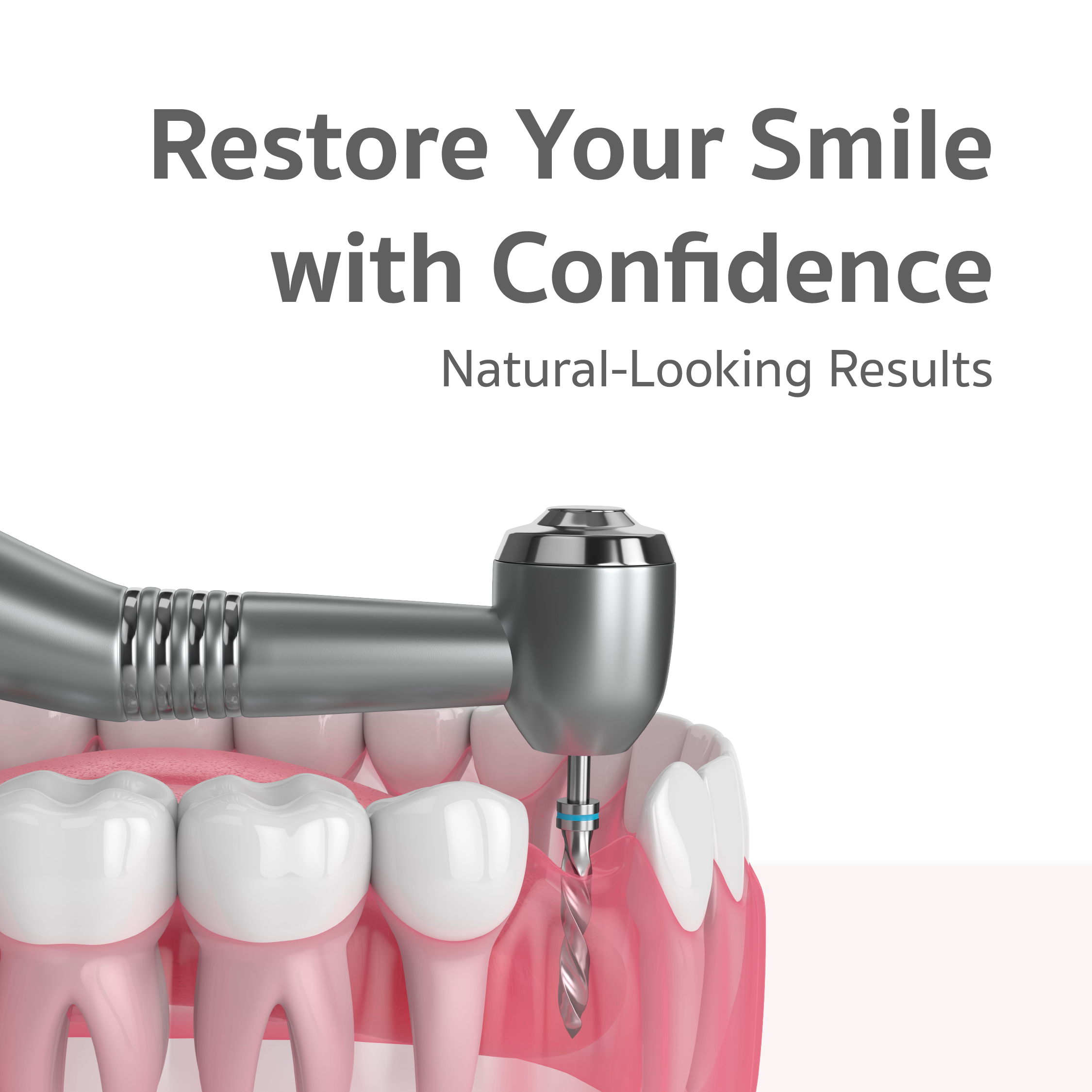 Dental Implants with Crown Package