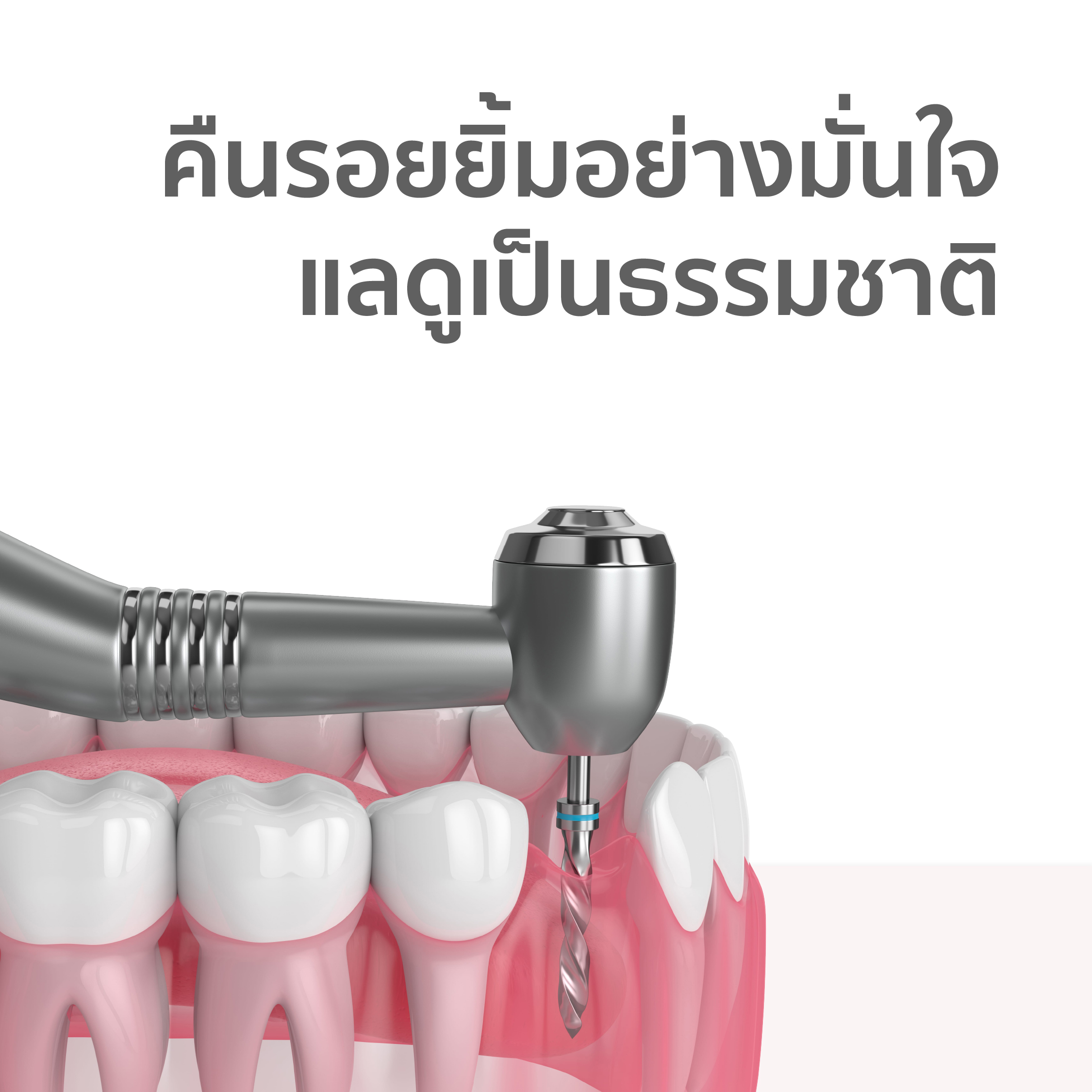แพ็กเกจรากฟันเทียมพร้อมครอบฟัน 