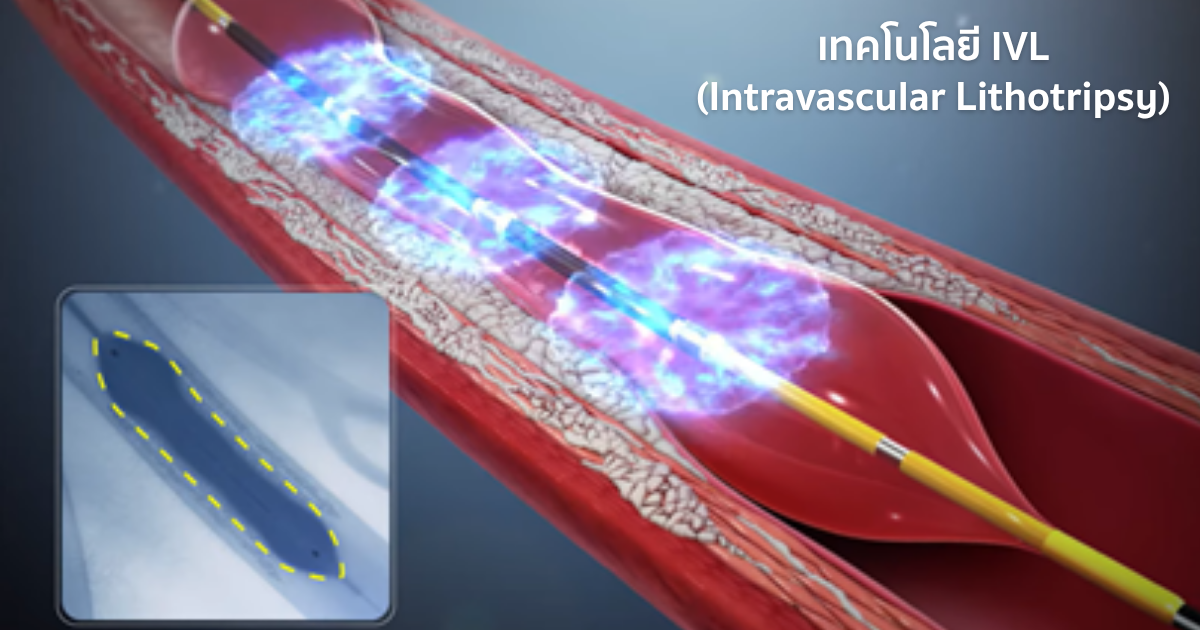 เทคโนโลยี IVL (Intravascular Lithotripsy) ทางเลือกใหม่ในการรักษาหลอดเลือดหัวใจตีบ Image