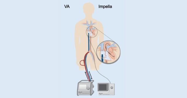 Miniature heart support device IMPELLA increases the chance of survival ...