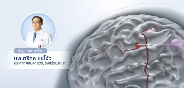 Endovascular Coiling ทางเลือกของการรักษา หลอดเลือดโป่งพองในสมอง (Brain Aneurysm) Image