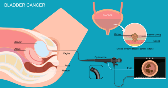 Bladder Cancer