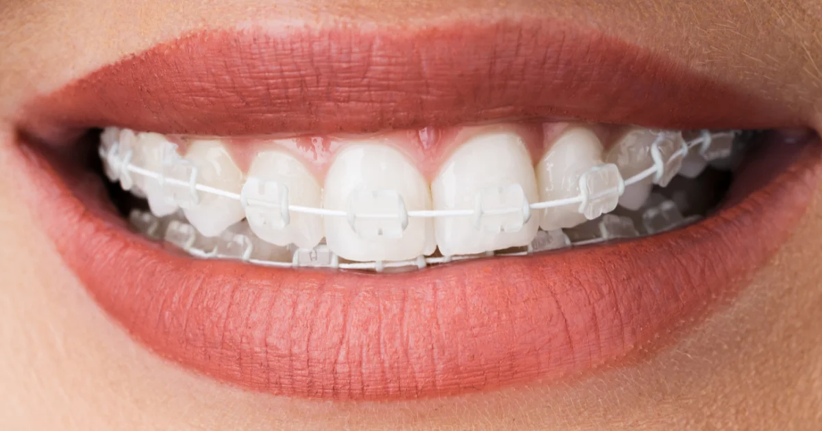 Ceramic braces