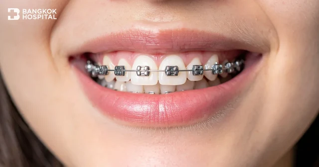 Which type of orthodontic braces should you choose? A complete summary of all advantages and points to consider before making a decision Image