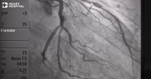 Coronary Angiogram Image