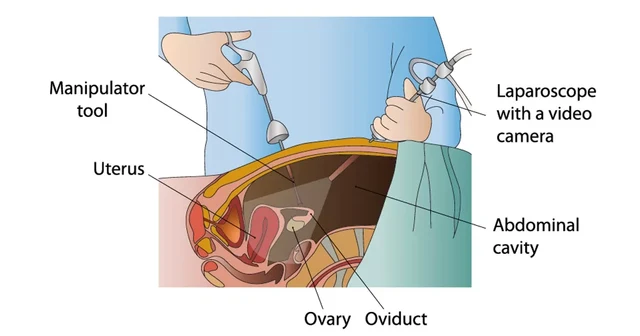 การผ่าตัดผ่านกล้องทางนรีเวช (Laparoscopic Gynecologic Surgery)