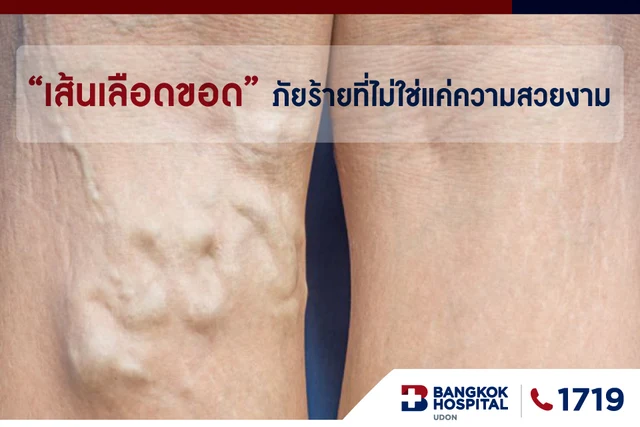 เส้นเลือดขอด........ภัยร้ายที่ไม่ใช่แค่ความสวยงาม