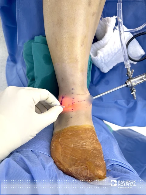 การผ่าตัดส่องกล้องซ่อมแซมเอ็นข้อเท้า (Ankle Arthroscopy with All-Inside Broström Internal Brace)