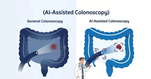 AI-Assisted Colonoscopy การส่องกล้องตรวจลำไส้ใหญ่ โดยใช้ AI มาช่วยแพทย์วิเคราะห์ภาพ Image