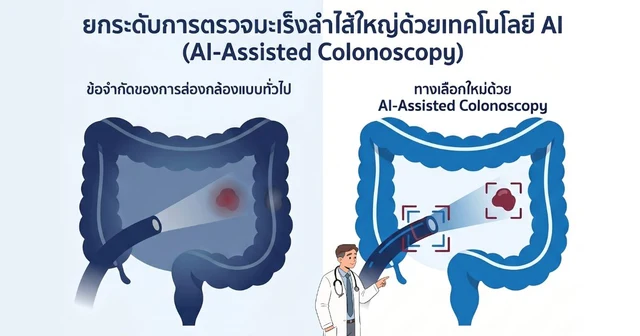 AI-Assisted Colonoscopy การส่องกล้องตรวจลำไส้ใหญ่ โดยใช้ AI มาช่วยแพทย์วิเคราะห์ภาพ