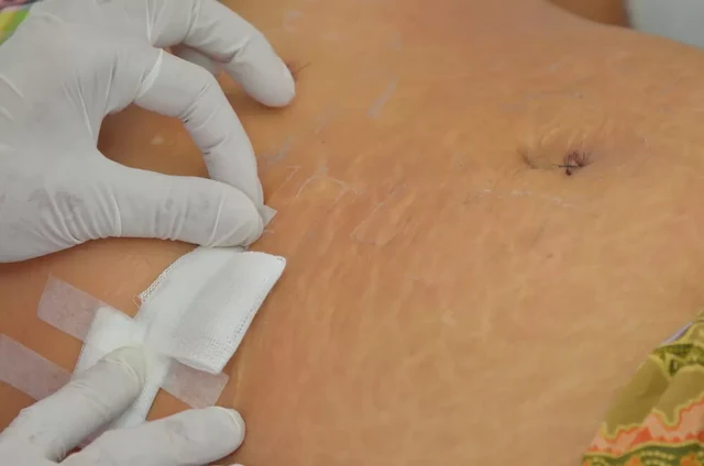 ส่องกล้องตรวจกระเพาะปัสสาวะแบบยืดหยุ่น (Flexible Cystoscopy) คืออะไร และเจ็บไหม?