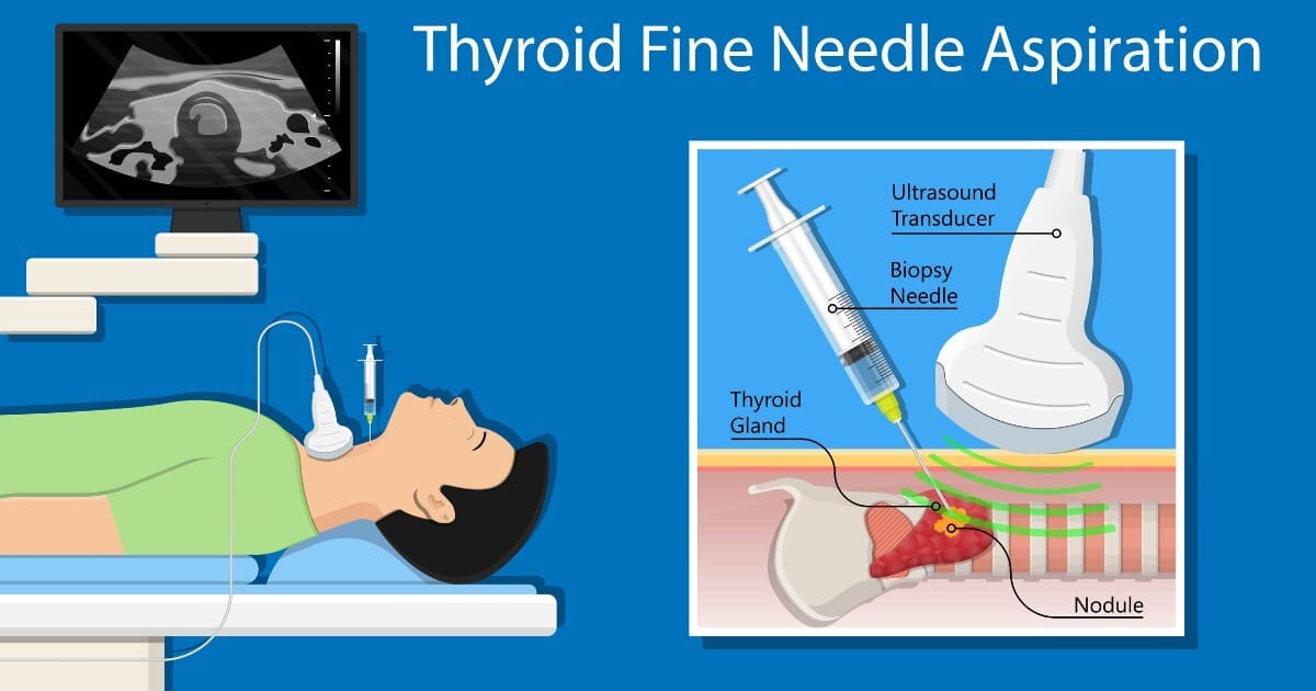 Thyroid FNA test