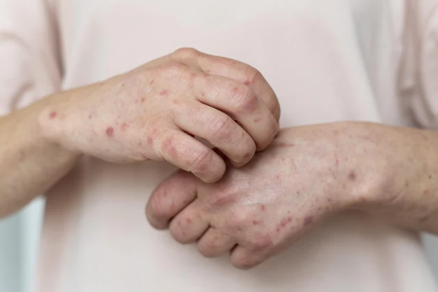 Chickenpox Vaccine – Prevent Before Illness, Reduce Risks & Complications Image