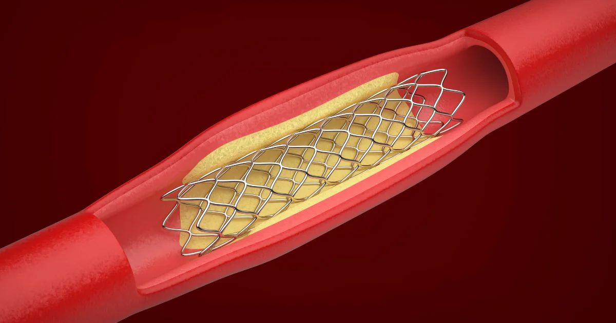 Ballonangioplastie am Herzen