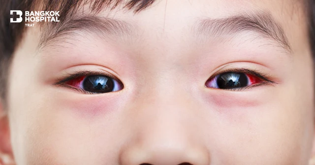Red Eye (Conjunctivitis) | Symptoms, Causes & Care