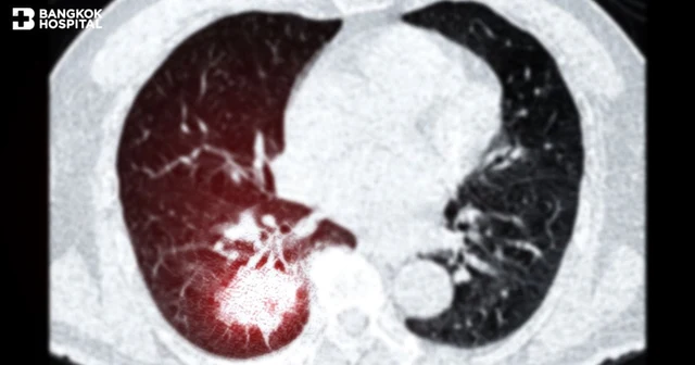 ตรวจคัดกรองมะเร็งปอดด้วยเอกซเรย์ช่องอกแบบรังสีต่ำ (Low-Dose Chest CT Scan-LDCT Chest) Image