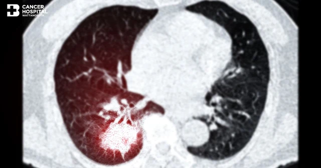Low-Dose Chest CT Scan (LDCT) ตรวจคัดกรองมะเร็งปอดด้วยเอกซเรย์ช่องอกแบบรังสีต่ำ Image