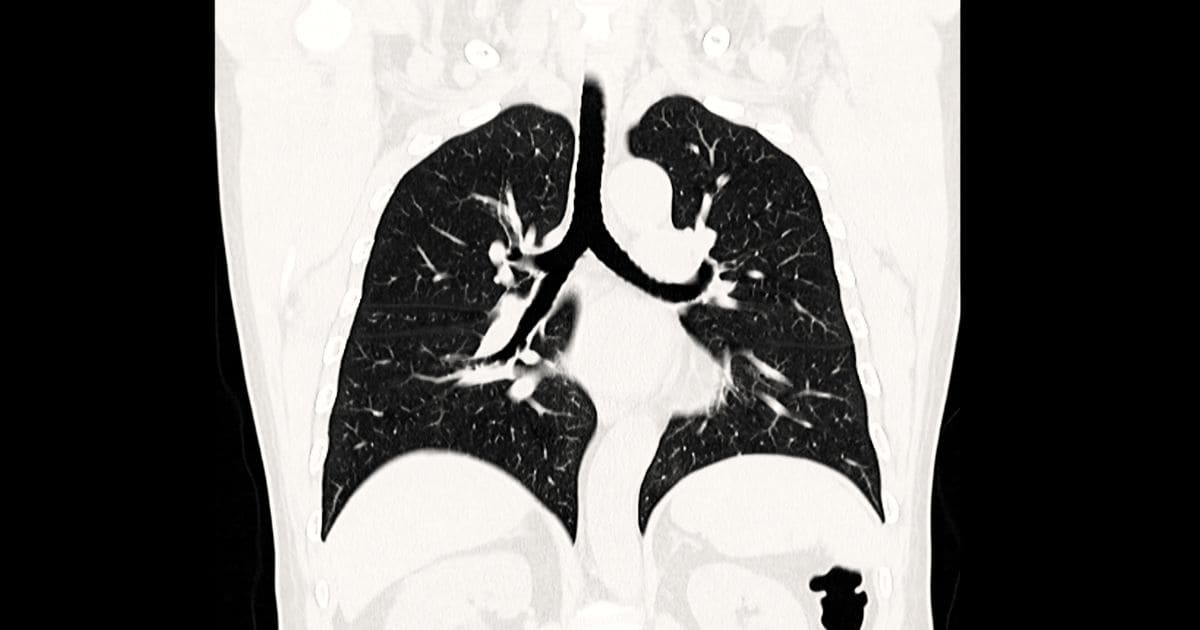 ตรวจคัดกรองมะเร็งปอดด้วยเอกซเรย์ช่องอกแบบรังสีต่ำ (Low-Dose Chest CT Scan-LDCT Chest)