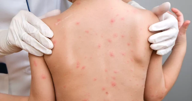How Measles Spreads: Key Facts Everyone Should Know