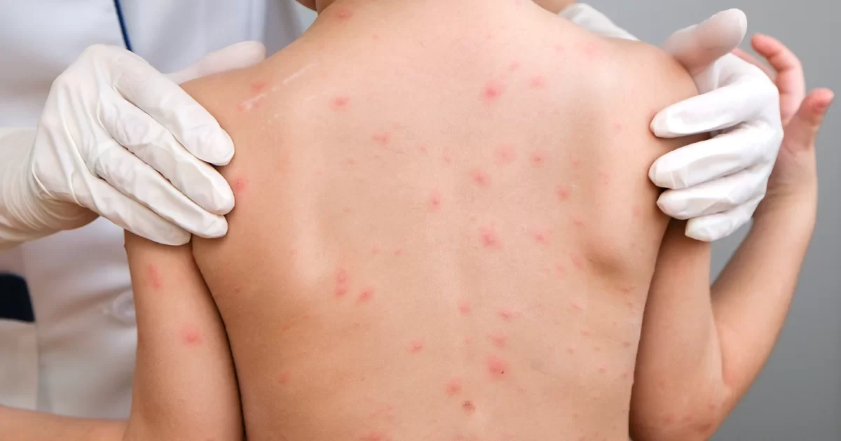 How Measles Spreads: Key Facts Everyone Should Know