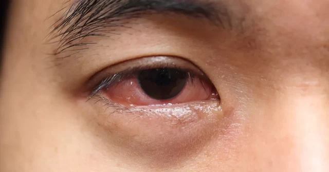 ทำความรู้จักเบาหวานขึ้นตา และการรักษาที่ทำได้ Image