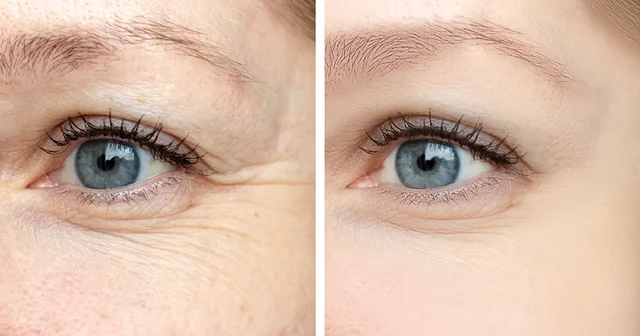 Botox Treatment