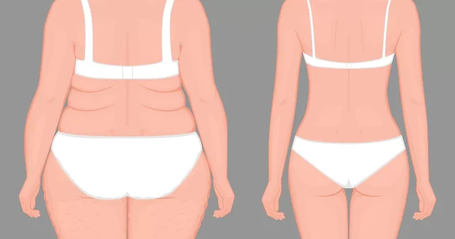 Liposuction
