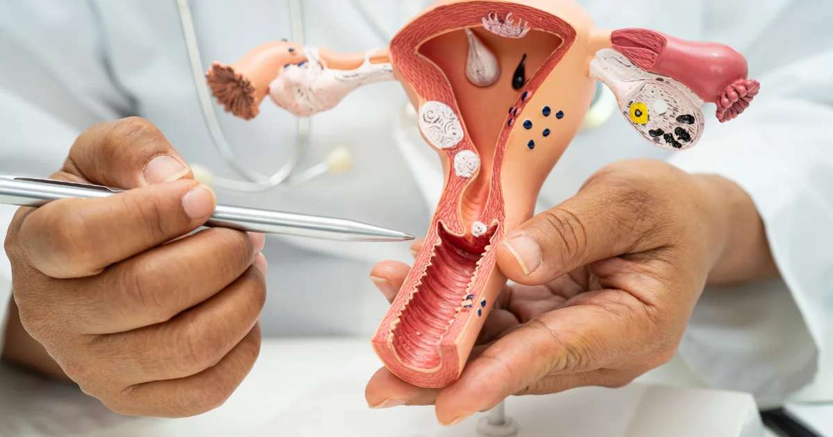 nteverted Uterus