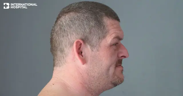 Acromegaly คืออะไร สาเหตุ อาการ และวิธีการรักษา Image