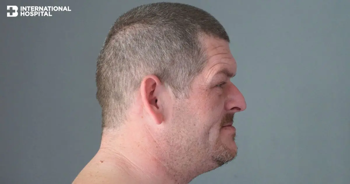 What is Acromegaly? Causes, symptoms, and treatment methods