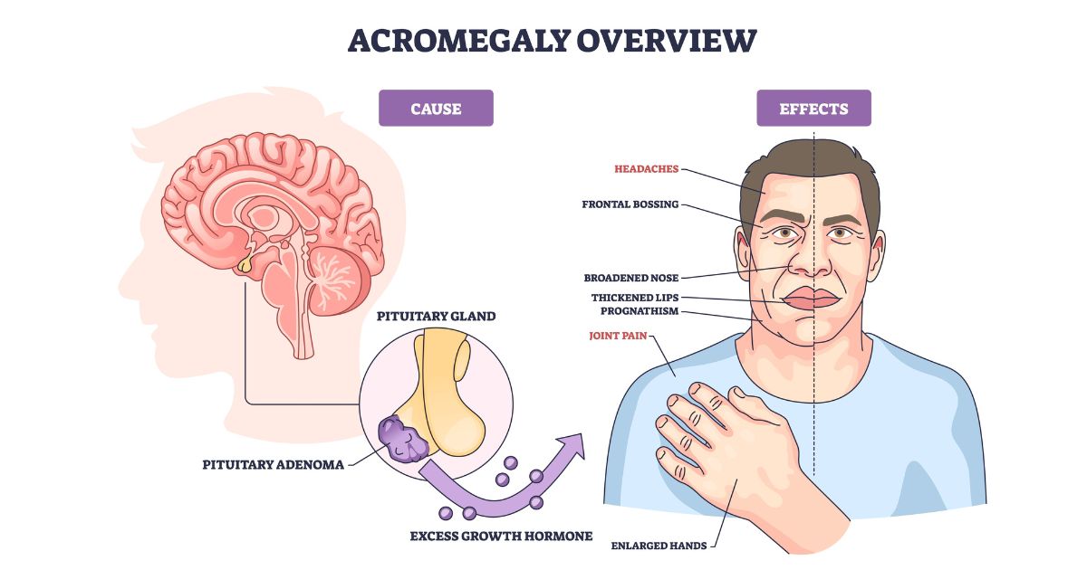 โรค Acromegaly เกิดจากอะไร