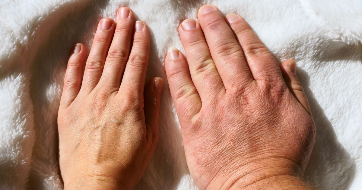 อาการของ โรค Acromegaly