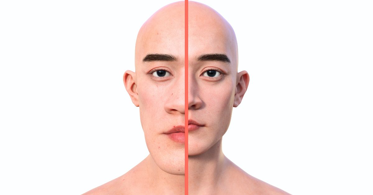 โรค Acromegaly