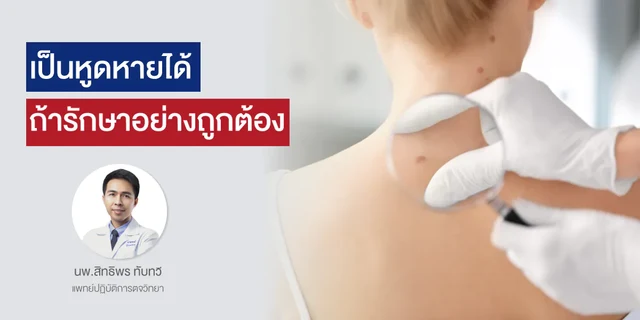 เป็นหูดหายได้ ถ้ารักษาอย่างถูกต้อง