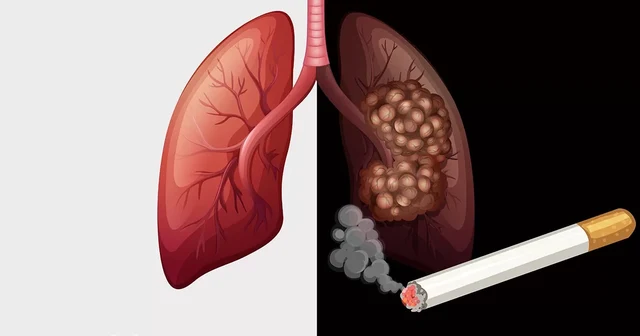 บุหรี่เผาปอด (Tobacco burns your lungs)