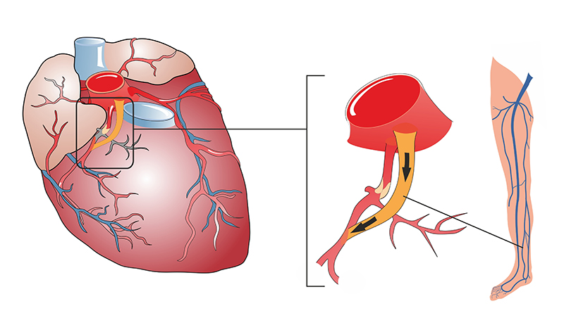 ผ่าตัดทำทางเบี่ยงหลอดเลือดหัวใจ, CABG