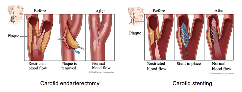 Carotid Duplex Ultrasound Test