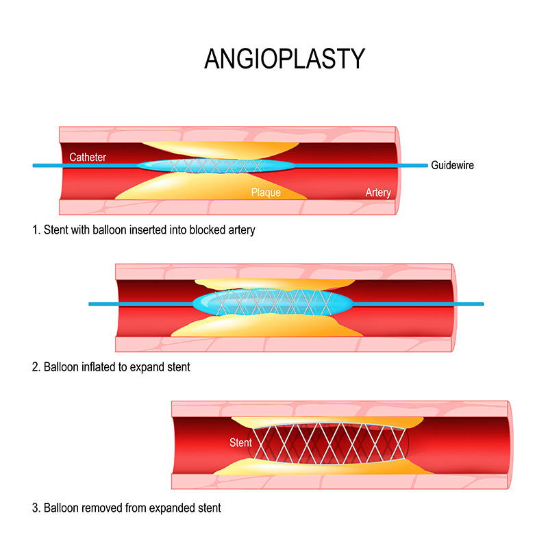 PERCUTANEOUS CORONARY INTERVENTION